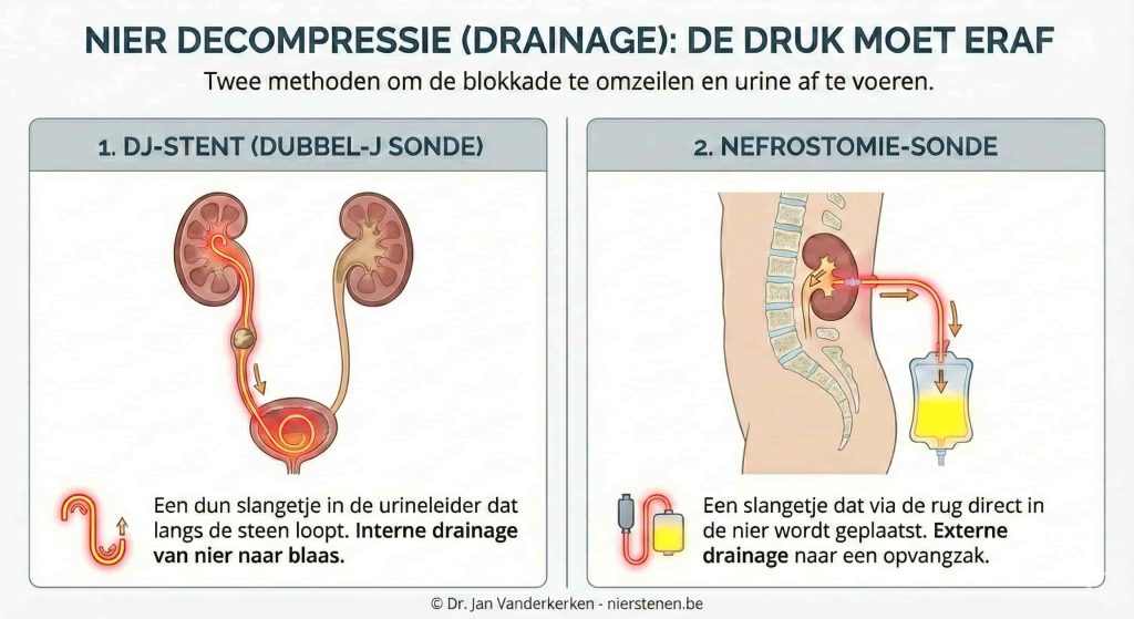 Medische infographic over nierdecompressie (drainage) om de druk van de nier te halen. Links: Een fluorescerende DJ-stent die in de urineleider langs een niersteen loopt voor interne drainage, afgezet tegen de normale anatomie aan de andere zijde. Rechts: Een nefrostomie-sonde die via de rug direct in de nier wordt geplaatst voor externe drainage naar een opvangzak. © Dr. Jan Vanderkerken - nierstenen.be